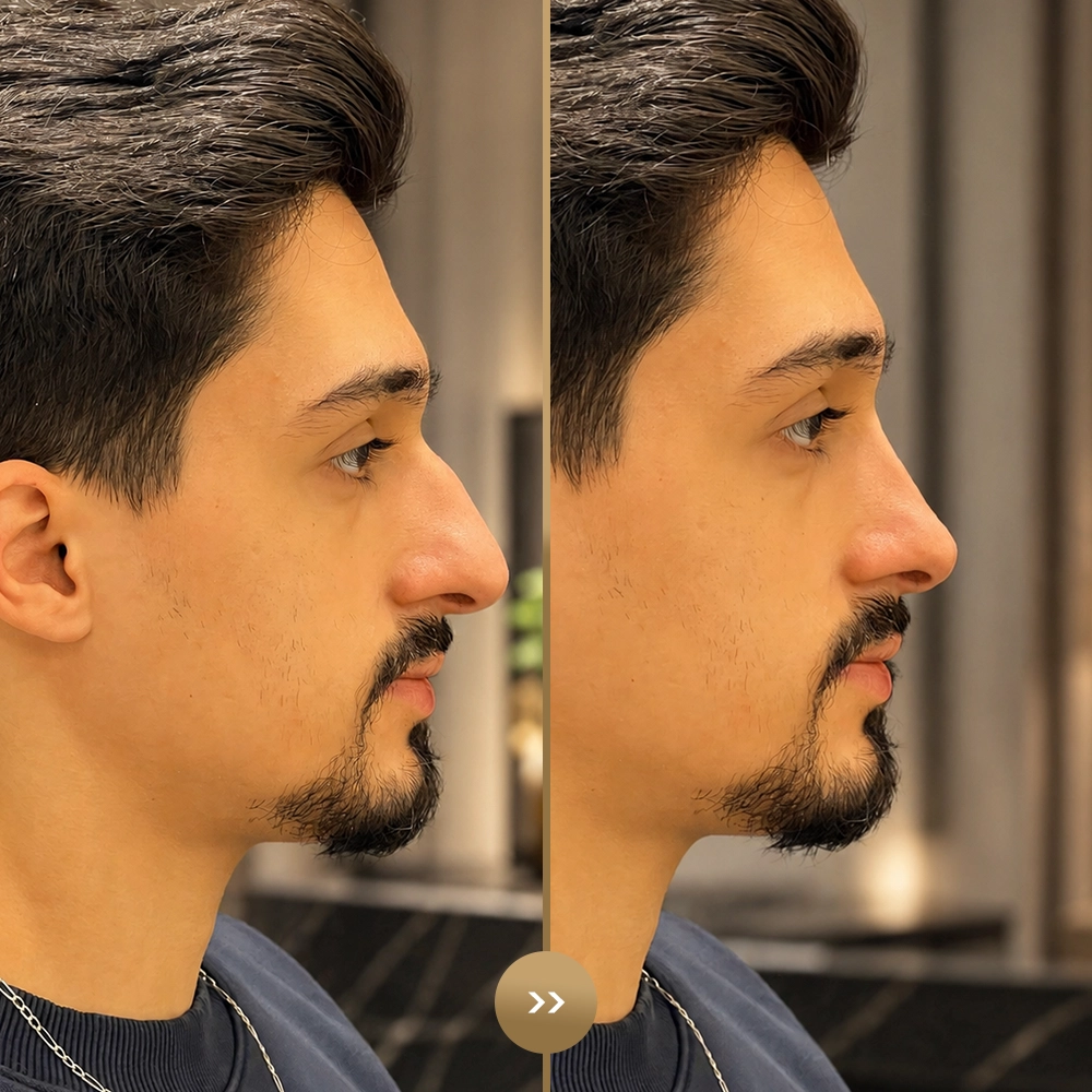 Rhinoplasty before and after