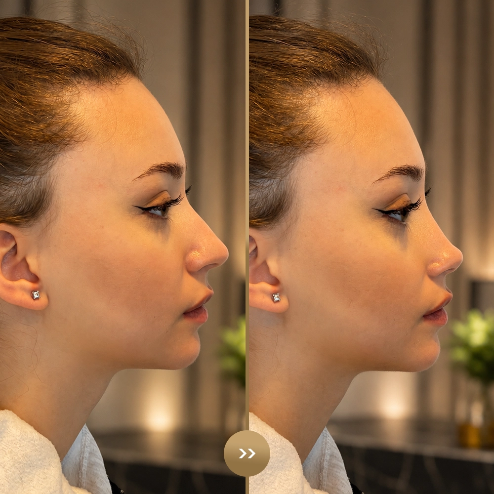 Female ethnic rhinoplasty