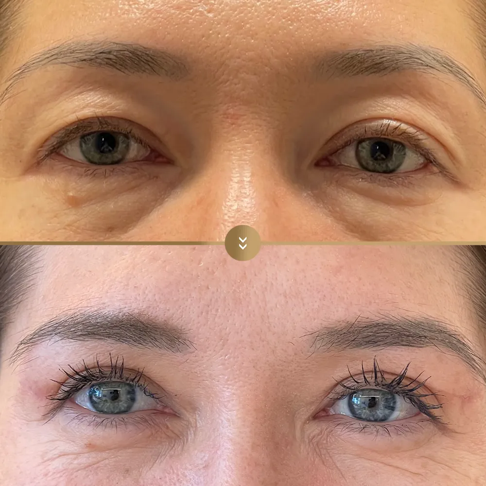 Eye contour aesthetics — before and after