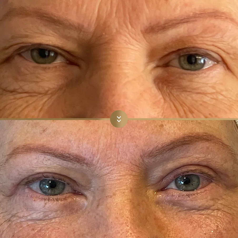 Eye contour aesthetics — before and after