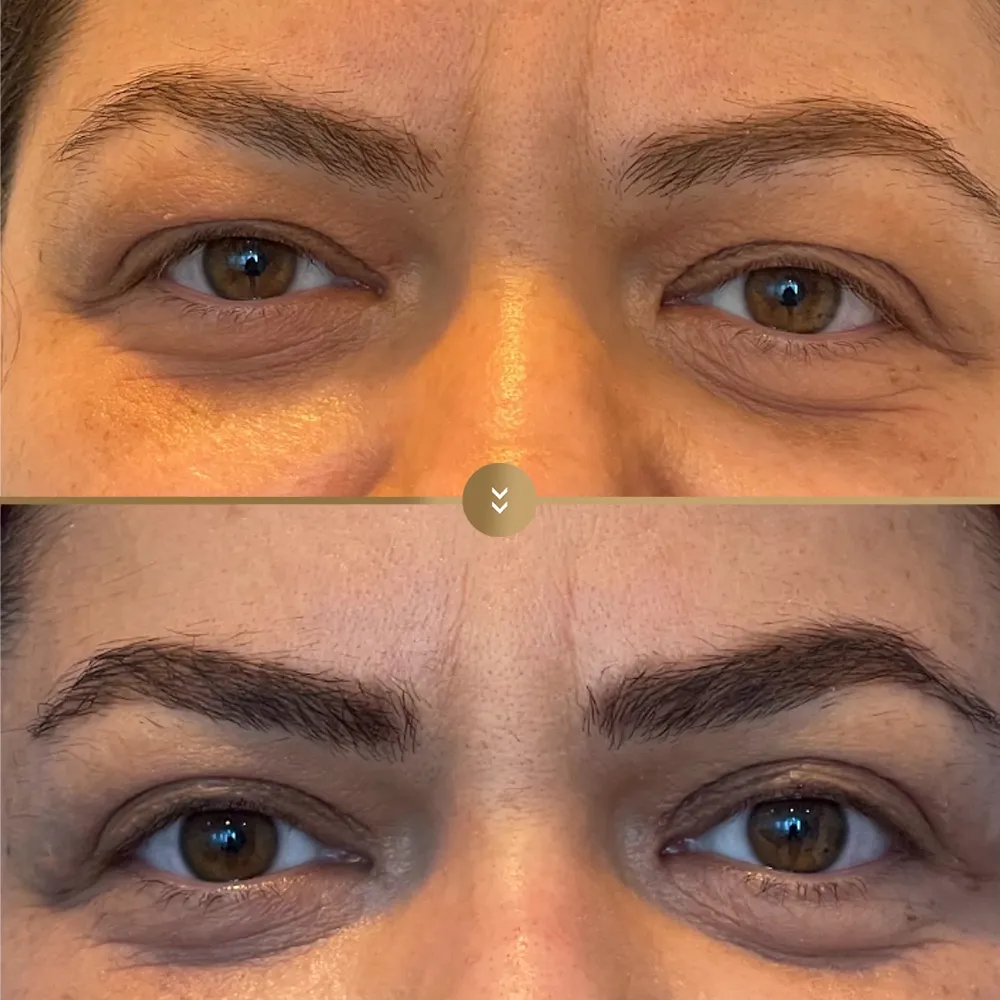 Eye contour aesthetics — before and after