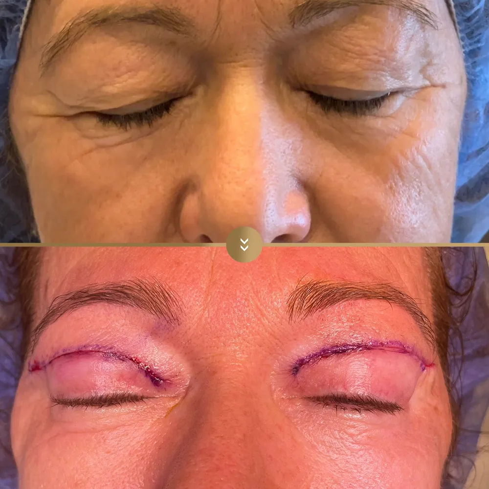 Eye contour aesthetics — before and after