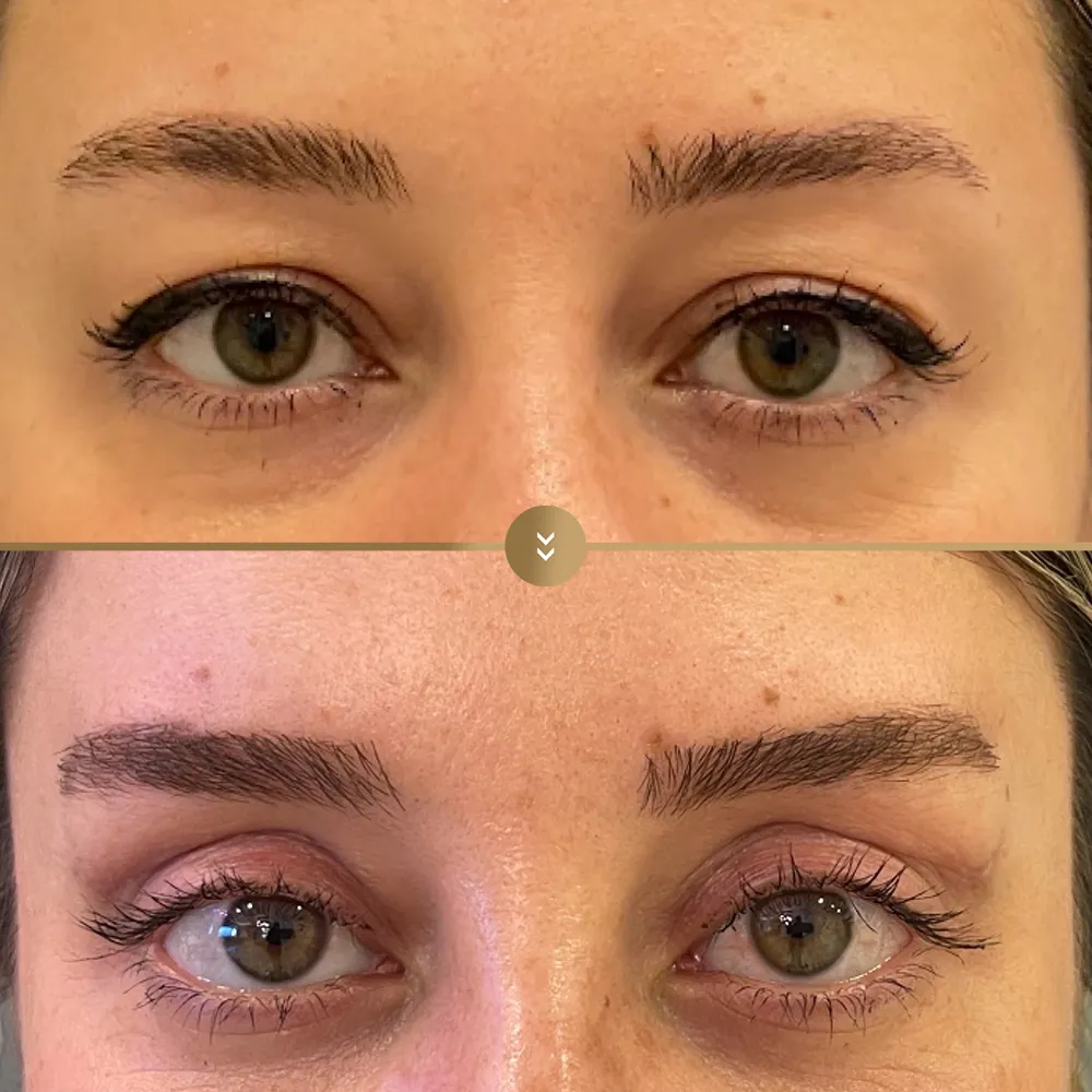 Eye contour aesthetics — before and after