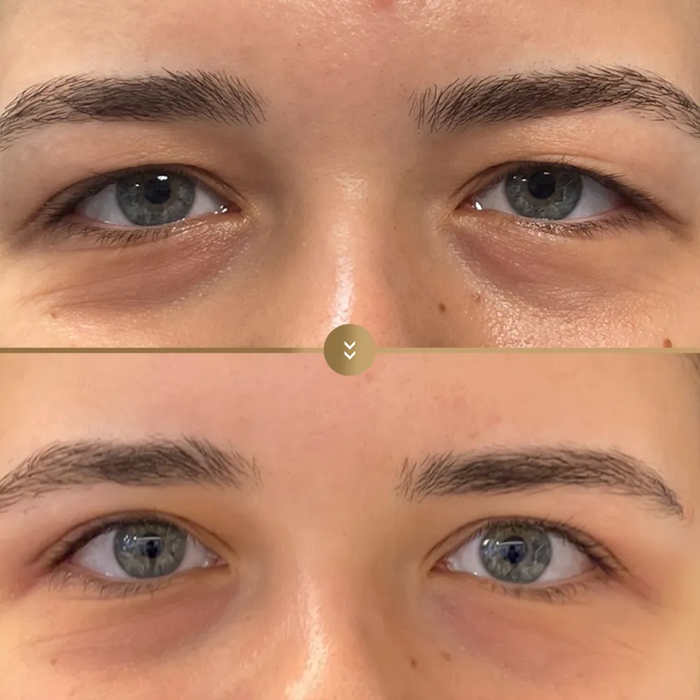Eye contour aesthetics — before and after