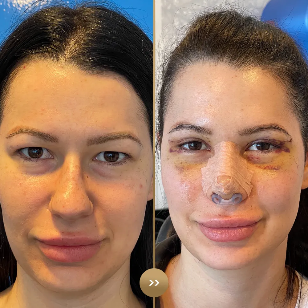 Eye contour aesthetics — before and after