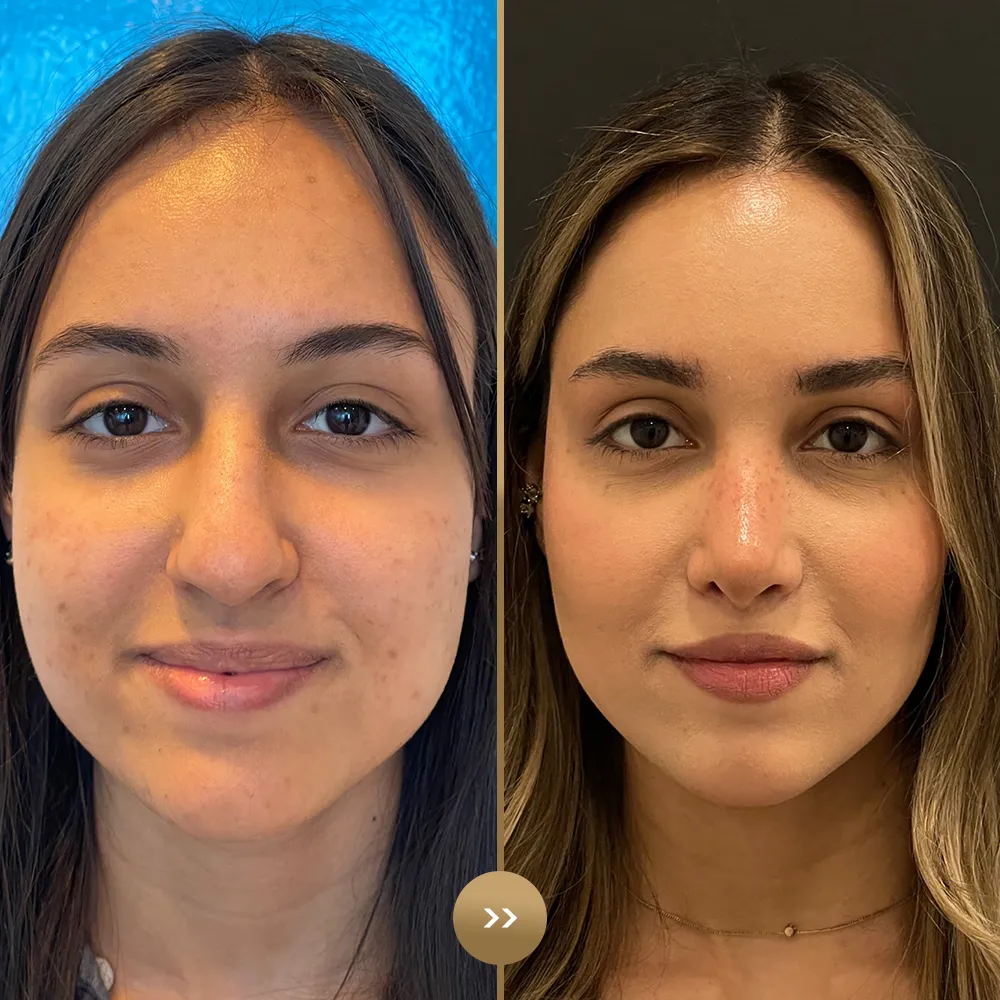 Rhinoplasty before and after — facial harmony