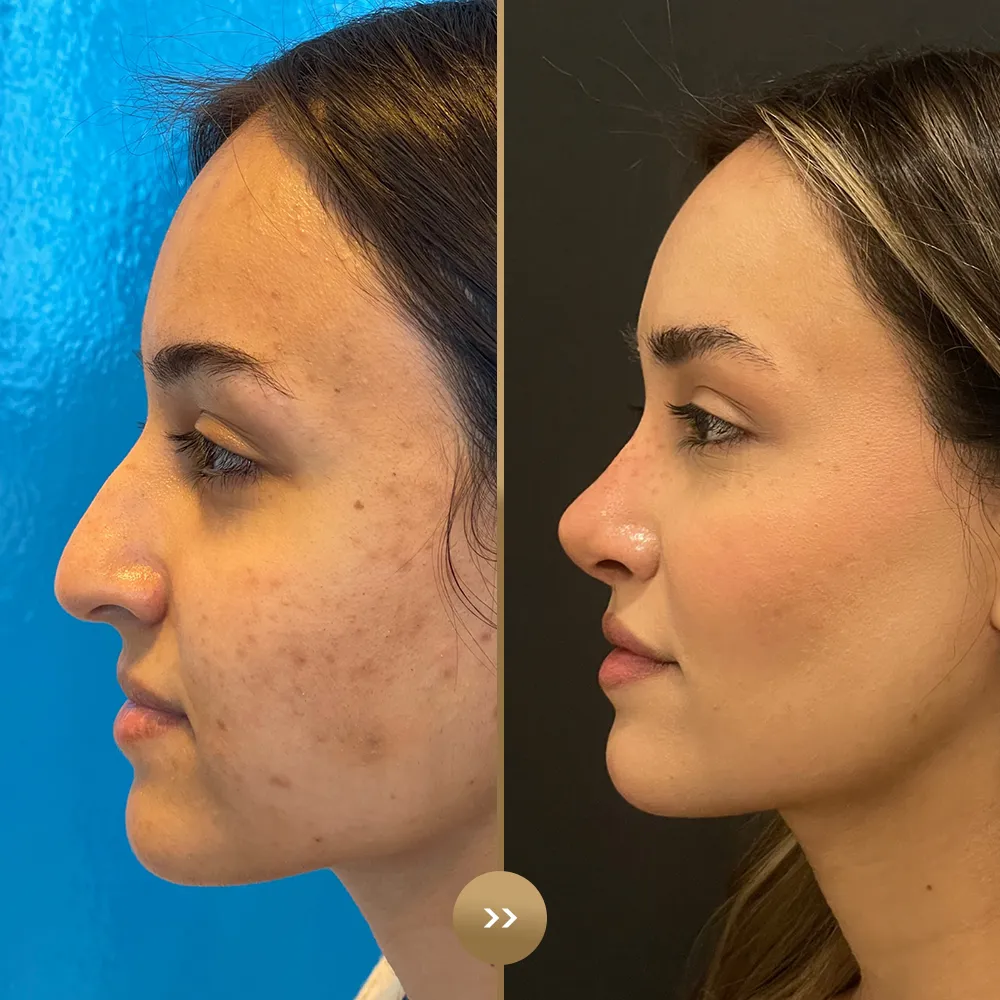 Rhinoplasty before and after — facial harmony