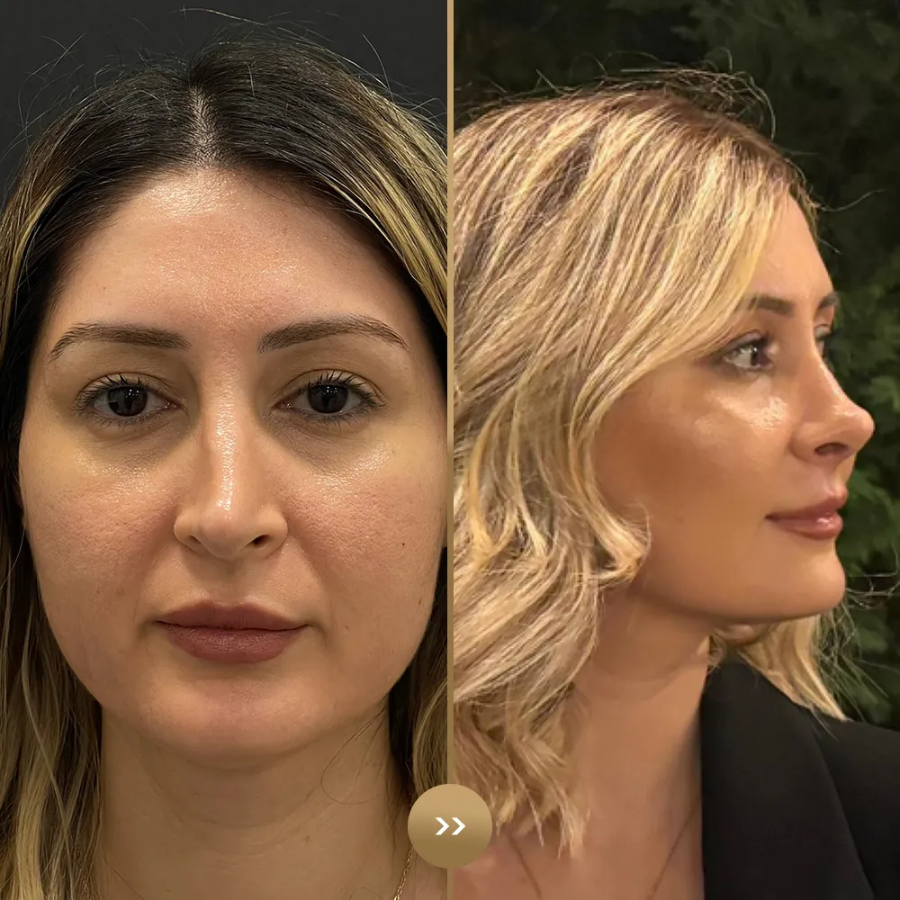 Rhinoplasty before and after — facial harmony