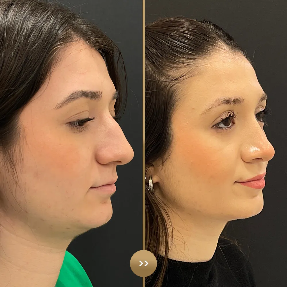 Rhinoplasty before and after — facial harmony