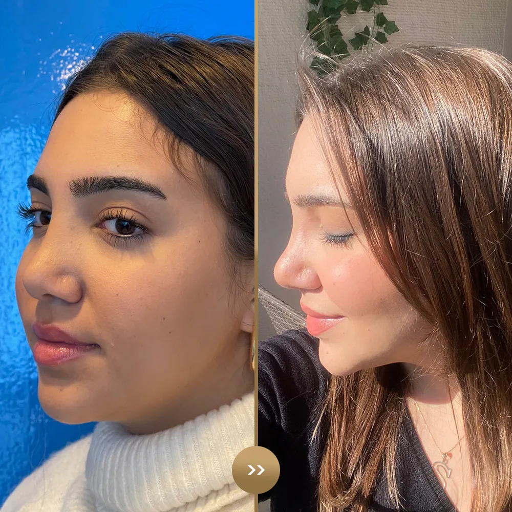 Rhinoplasty before and after — facial harmony