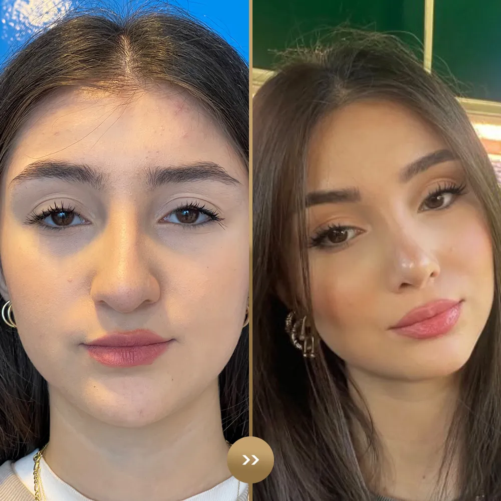 Rhinoplasty before and after — facial harmony