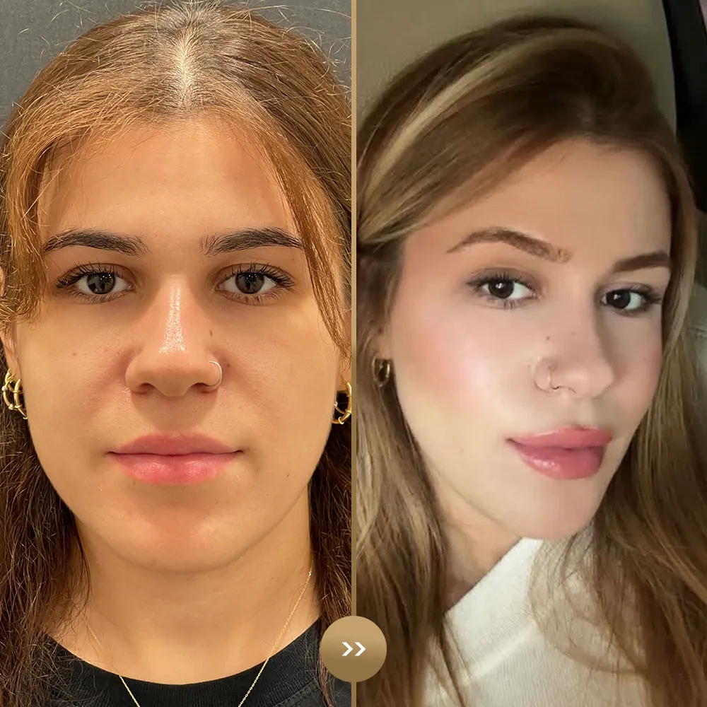 Rhinoplasty before and after — facial harmony