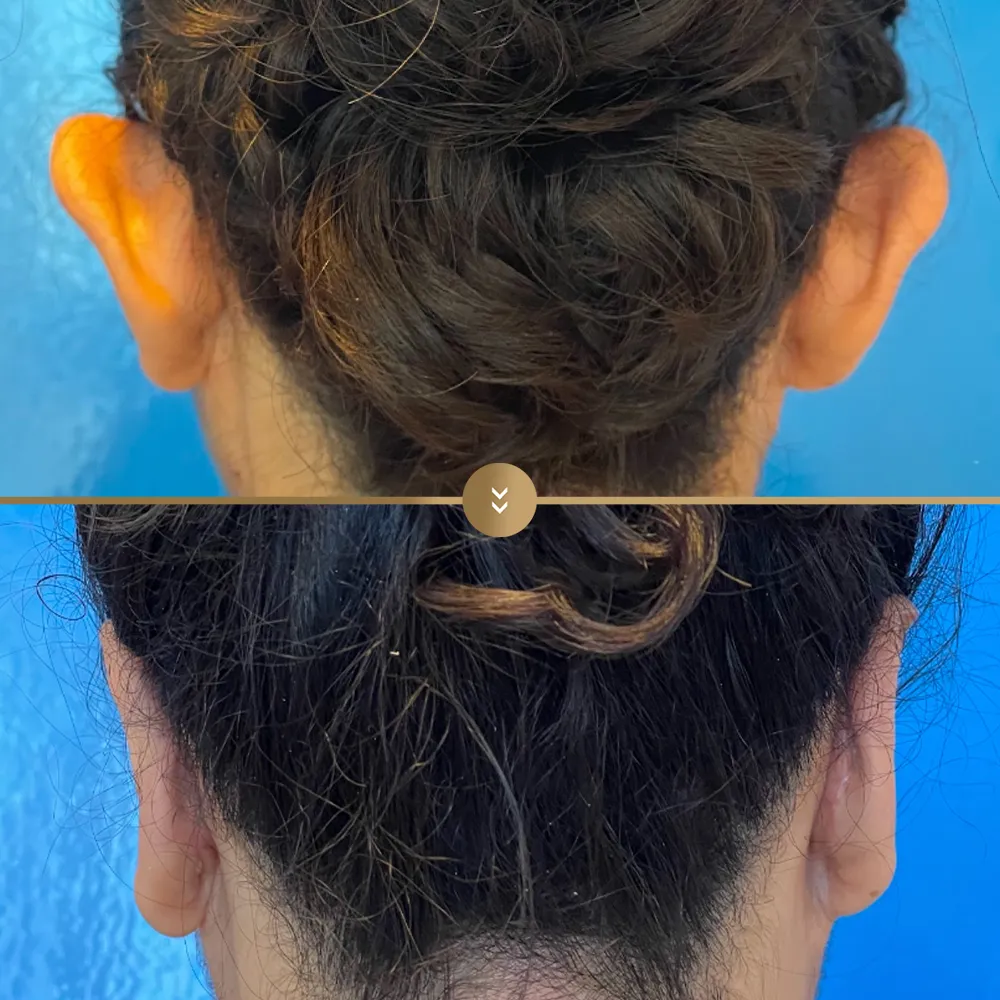 Otoplasty (ear reshaping) before and after