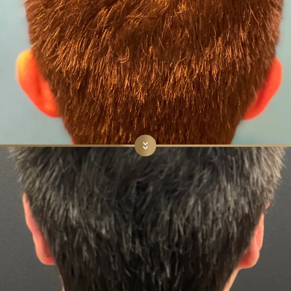 Otoplasty (ear reshaping) before and after