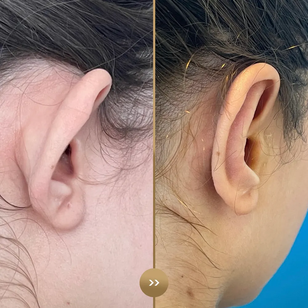 Otoplasty (ear reshaping) before and after