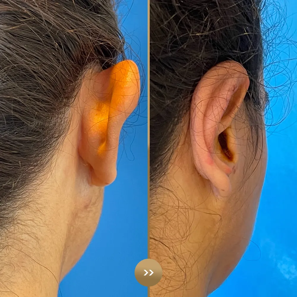 Otoplasty (ear reshaping) before and after