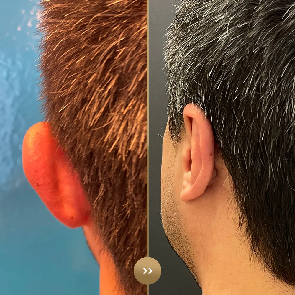 Otoplasty (ear reshaping) before and after