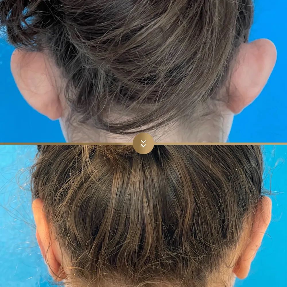 Otoplasty (ear reshaping) before and after